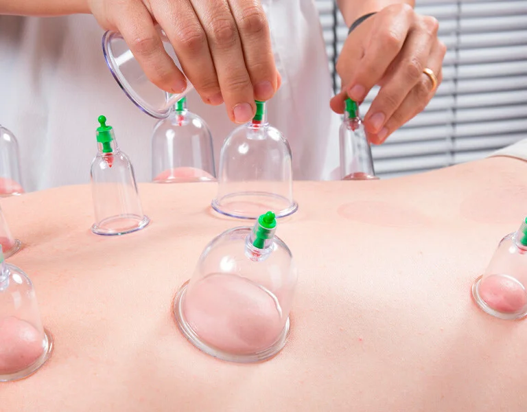 cupping service
